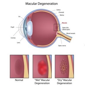 Eyes on Brickell: Macular Degeneration common_eye_problem