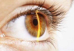 Eyes on Brickell: Things you need to know about Laser eye surgery