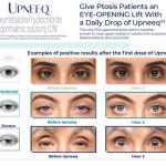 Eyes on Brickell: Upneeq Give ptosis patients an eye-opening lift with a daily drop of upneeq