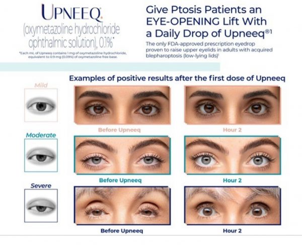 Eyes on Brickell: Upneeq Give ptosis patients an eye-opening lift with a daily drop of upneeq
