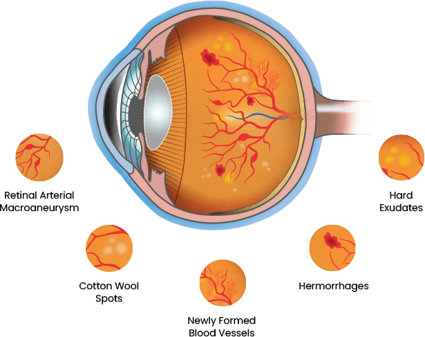 Book an appointment For The Diabetic Retinopathy Test - Eyes On Brickell Eyes on Brickell: Diabetic Retinopathy