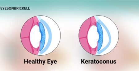 Keratoconus