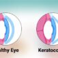 Keratoconus